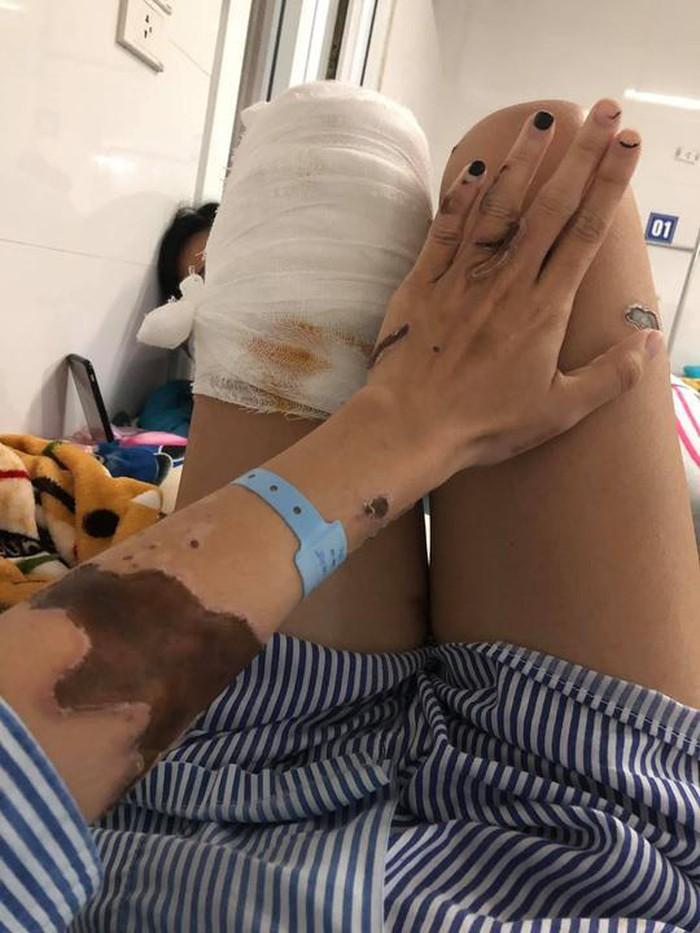 Tước quân tịch, bắt giam thiếu úy công an tạt axit vợ sắp cưới-1