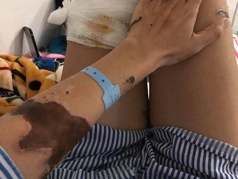 Cô gái xinh đẹp bị chồng sắp cưới tạt axit: Tôi trắng tay rồi-3