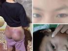 Nghi trộm tiền, bé gái ở Hà Tĩnh bị công an viên đánh bầm tím