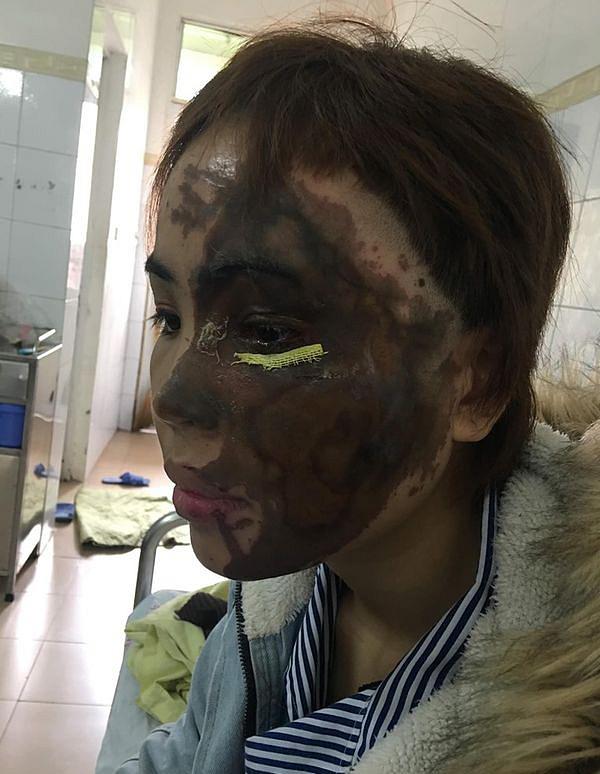 Hành trình hồi sinh gương mặt xinh đẹp cho cô gái bị thiếu úy tạt axit-2