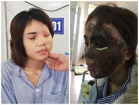 Thiếu úy công an tạt axit vào mặt vợ sắp cưới có thể chịu mức án nào?-3