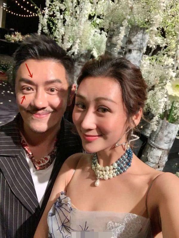 Xuất hiện với diện mạo bọng mắt sưng, đầu mũi to, Trần Hạo Dân phẫu thuật thẩm mỹ thất bại?-4