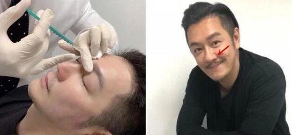 Xuất hiện với diện mạo bọng mắt sưng, đầu mũi to, Trần Hạo Dân phẫu thuật thẩm mỹ thất bại?-7