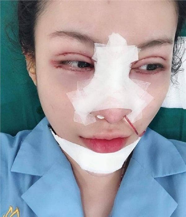 Mạng xã hội Việt dậy sóng với màn lột xác những tưởng chỉ có trên phim của cô gái trẻ sau thẩm mỹ-2
