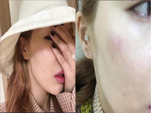 HyunA trấn an fan sau cú ngã trời giáng trên sân khấu: 'Tôi đã chụp CT đầu, quét X-Quang cổ tay,… mọi thứ rất ổn'