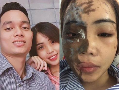 Vụ cựu công an tạt axit vợ sắp cưới: Tại sao giám định thương tích hai lần khác nhau?-3