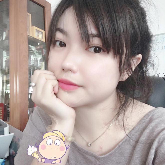 Cô gái xinh đẹp bị tạt axit và 20 lần phẫu thuật lấy lại diện mạo-3