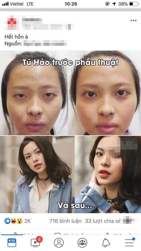 Sau 2 năm đăng quang, Tú Hảo vẫn bị lôi ảnh bị nghi là phẫu thuật thẩm mỹ ra bàn tán-1