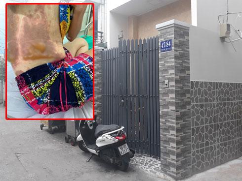 Mâu thuẫn chuyện đỗ xe, người phụ nữ bị tạt cả chảo dầu đang chiên cá gây bỏng nặng