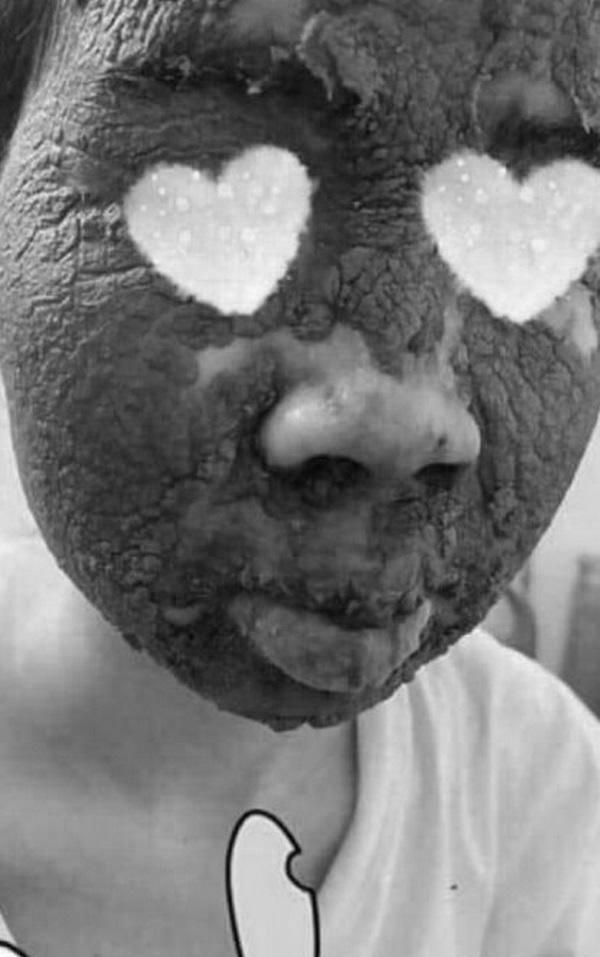 Nhầm tưởng lên đời nhan sắc nhờ rượu thuốc, cô gái khóc ròng vì làn da nham nhở, sần sùi-2