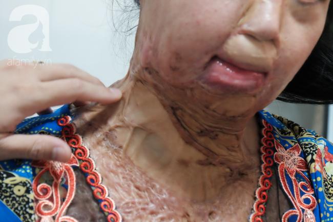 Vừa chia tay chồng, người phụ nữ bị kẻ lạ tạt axit, đau đớn khi con trai 8 tuổi sợ hãi, không nhận ra mẹ-5