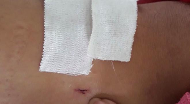 Bệnh nhân gãy đốt sống ngực bị khoan nhầm cẳng chân-2