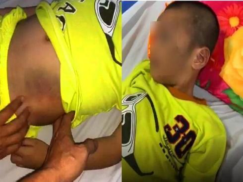 Sức khỏe bé trai bị mẹ cùng người tình đồng tính bạo hành ra sao?