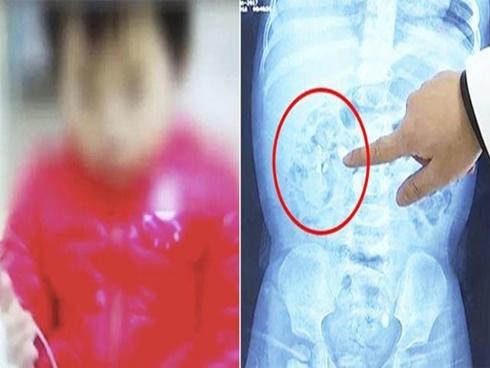 Bé 9 tháng tuổi thận đầy sỏi do bổ sung quá liều canxi