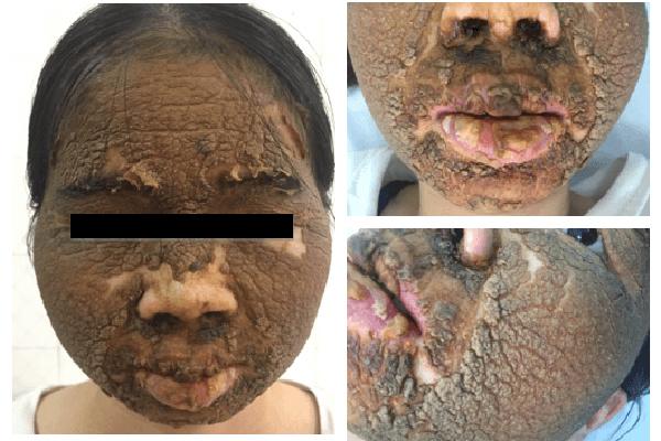 Mặt cô gái Hà Nội sần như vỏ cây vì bôi kem trắng da-1