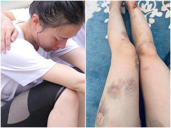 Phương Oanh khoe đôi chân bầm tím, sứt cả mảng da cực kỳ đáng sợ