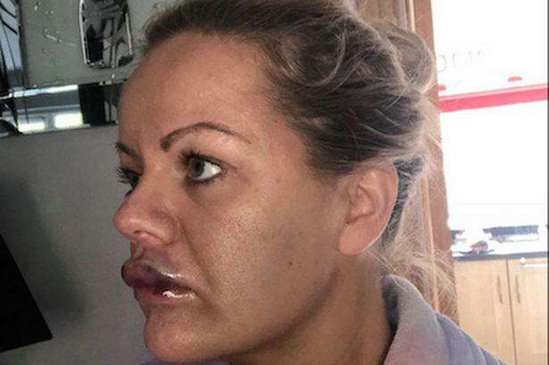 Suýt mù mắt, hỏng môi vì tiêm filler làm đầy khuôn mặt-2