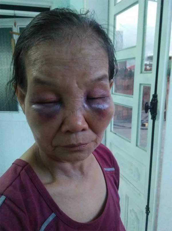 Vụ mẹ chồng bị con dâu đánh bầm dập chỉ vì cái bô: Bà ấy thường lấy nước tiểu trừ tà để tôi ngoan hơn-2