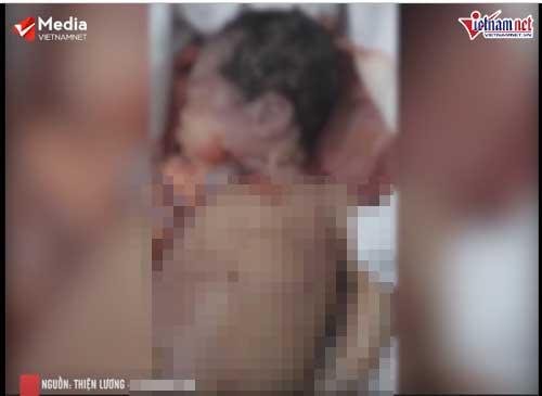 Vụ trẻ sơ sinh bị bác sĩ kéo đứt cổ: Bản tường trình của kíp trực viết rõ chính bác sĩ kéo đứt lìa đầu thai nhi-1