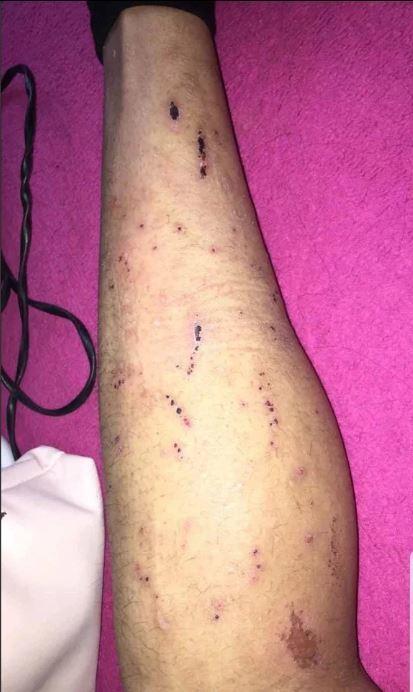 Bác sĩ chẩn đoán bị ghẻ, cô gái 24 tuổi không ngờ là ung thư suốt nhiều năm-1