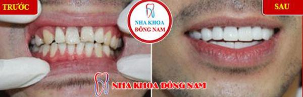 Người nổi tiếng trồng răng loại nào chất lượng?-3