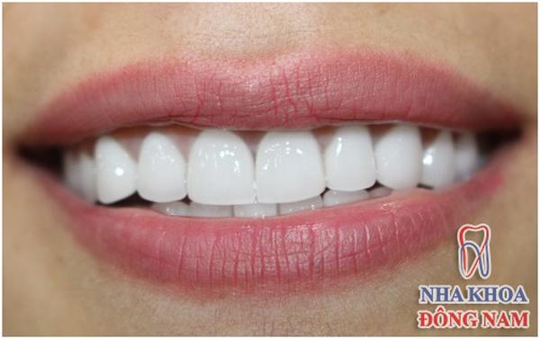 Người nổi tiếng trồng răng loại nào chất lượng?-1