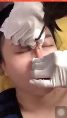 RÙNG MÌNH và PHẪN NỘ trước clip tiêm filler rồi nắn sống mũi như nặn đất sét của cô gái trẻ-4