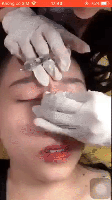 RÙNG MÌNH và PHẪN NỘ trước clip tiêm filler rồi nắn sống mũi như nặn đất sét của cô gái trẻ-1