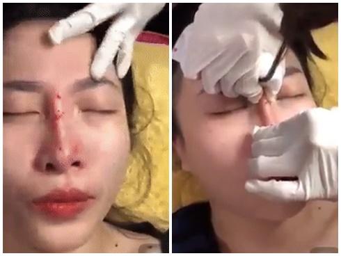 RÙNG MÌNH và PHẪN NỘ trước clip tiêm filler rồi nắn sống mũi như nặn đất sét của cô gái trẻ