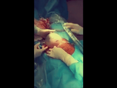 Clip: Em bé chào đời còn nằm nguyên trong bọc ối, chớp mắt mỉm cười với bác sĩ cực cute-1