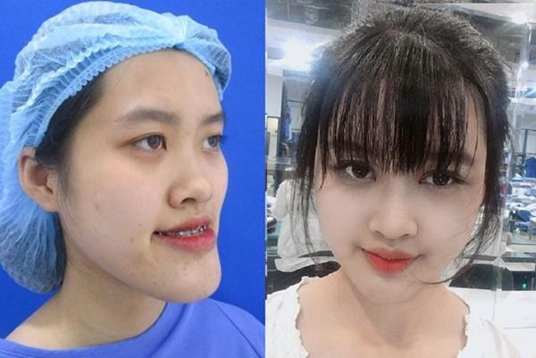 Nữ sinh trường Cảnh sát thay đổi ngoại hình sau phẫu thuật thẩm mỹ-1