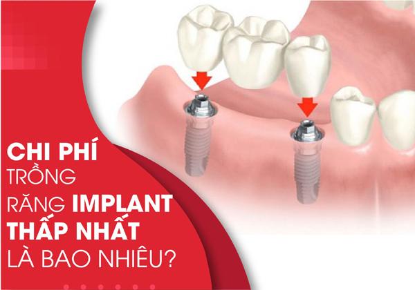 Chi phí trồng răng Implant ở Nha Khoa Đông Nam-1