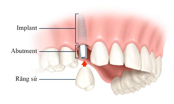 Chi phí trồng răng Implant ở Nha Khoa Đông Nam-2