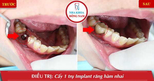 Chi phí trồng răng Implant ở Nha Khoa Đông Nam-5