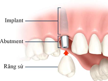 Chi phí trồng răng Implant ở Nha Khoa Đông Nam