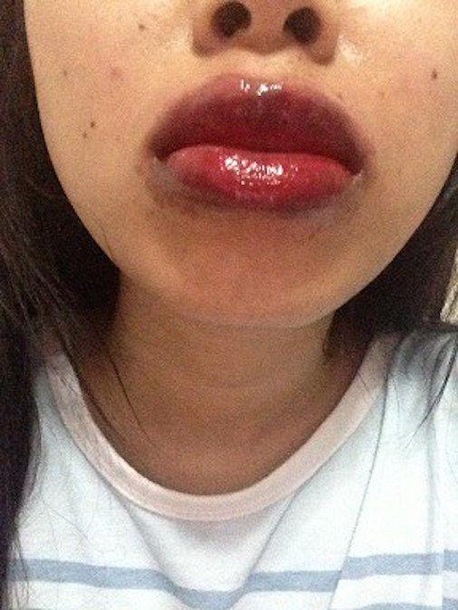 Rùng mình đôi môi cô gái trẻ sưng như 2 miếng thịt bò khô vì phun xăm hỏng, cứ nói 1 câu lại ứa máu đau đớn-4