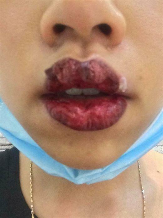 Rùng mình đôi môi cô gái trẻ sưng như 2 miếng thịt bò khô vì phun xăm hỏng, cứ nói 1 câu lại ứa máu đau đớn-5