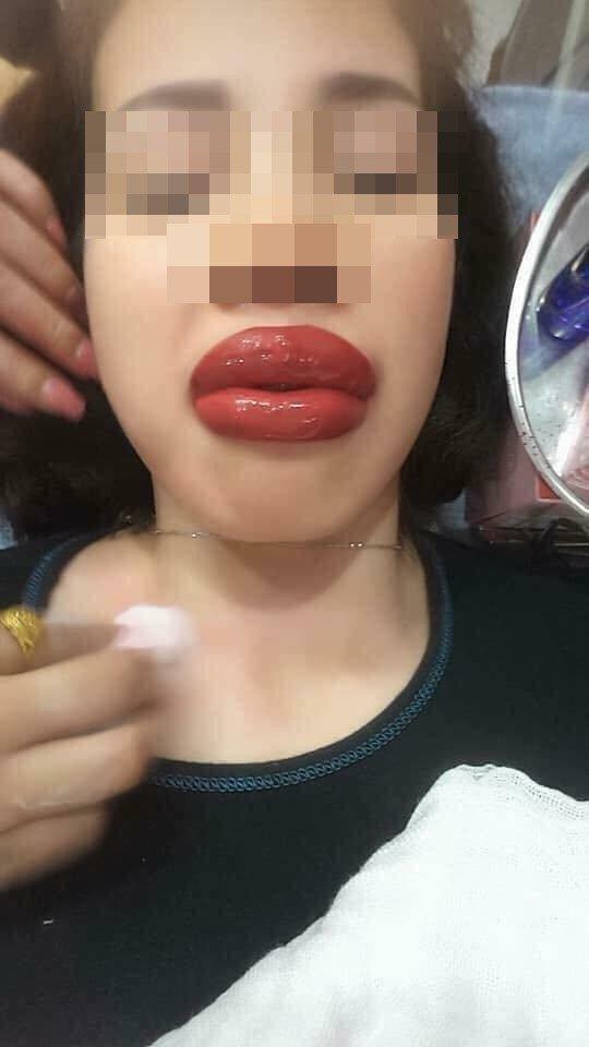 Rùng mình đôi môi cô gái trẻ sưng như 2 miếng thịt bò khô vì phun xăm hỏng, cứ nói 1 câu lại ứa máu đau đớn-2
