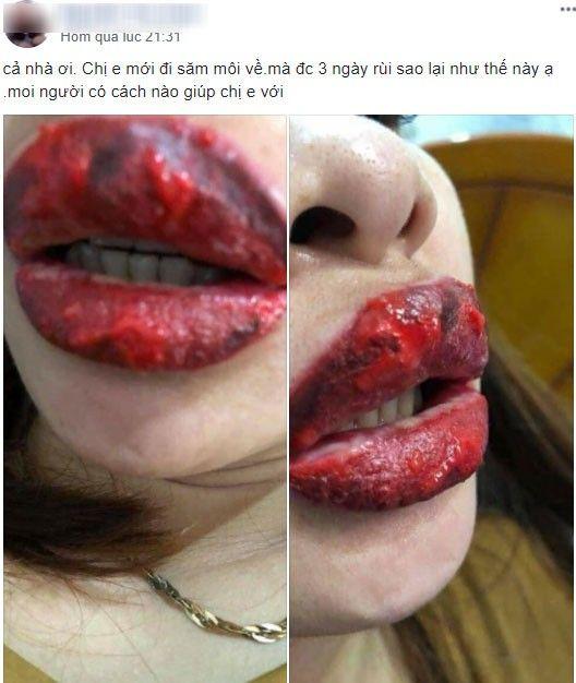 Rùng mình đôi môi cô gái trẻ sưng như 2 miếng thịt bò khô vì phun xăm hỏng, cứ nói 1 câu lại ứa máu đau đớn-3