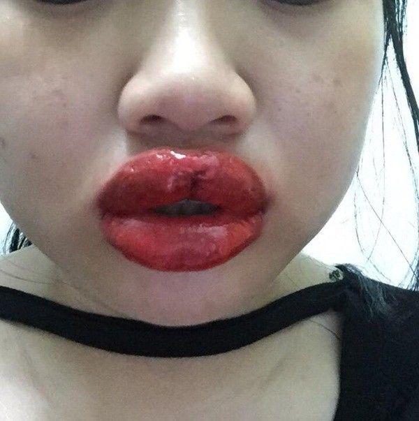 Rùng mình đôi môi cô gái trẻ sưng như 2 miếng thịt bò khô vì phun xăm hỏng, cứ nói 1 câu lại ứa máu đau đớn-6