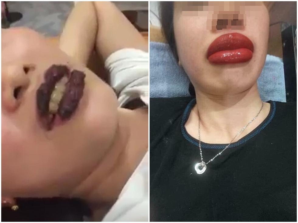 Hết bị nghi sửa mũi, Mai Thu Huyền lại lộ hình ảnh mắt sưng húp ở thẩm mỹ viện-6