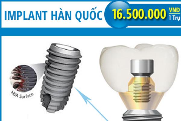 Chi phí trồng răng Implant ở Nha Khoa Đông Nam-6