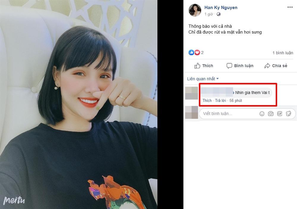 Tưởng cắt chỉ thẩm mỹ xong sẽ xinh đẹp hơn, ai dè gương mặt Kỳ Hân lại bị chê đơ như cây cơ-6