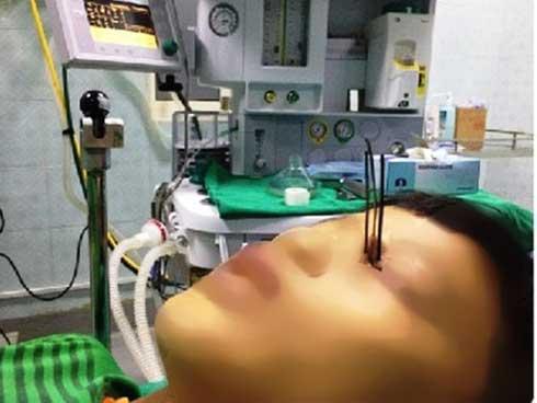 Dùng súng tự chế đi bắt cá, nam sinh bị 3 mũi tên xuyên vào mắt