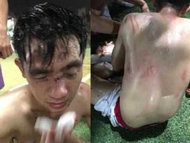 Hà Nội: Tranh chấp khi đá bóng, 15 cầu thủ lao vào đánh đối phương nhập viện Hà Nội: Tranh chấp khi đá bóng, 15 cầu thủ lao vào đánh đối phương nhập viện