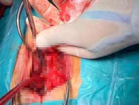 Mâu thuẫn, nam thanh niên cầm que xiên thịt đâm vào lưng bạn Mâu thuẫn, nam thanh niên cầm que xiên thịt đâm vào lưng bạn