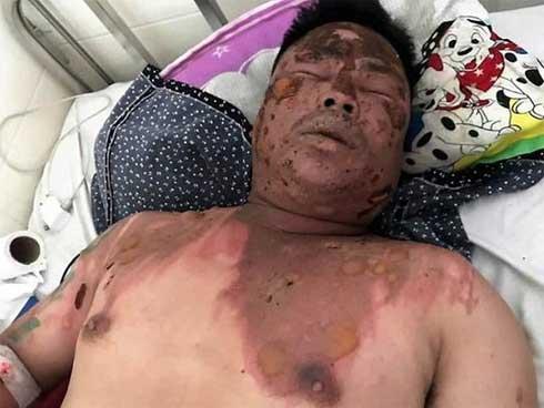 Chỉ muốn hỏi tuổi bố bạn nhậu cho dễ gọi, nam thanh niên ở Lâm Đồng bị hất cả nồi lẩu đang sôi sùng sục vào mặt