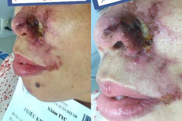 Người phụ nữ Hà Nội bị thối mũi, chảy mủ sau tiêm filler-1