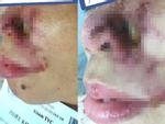Người phụ nữ Hà Nội bị thối mũi, chảy mủ sau tiêm filler