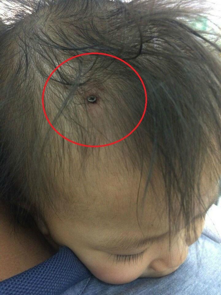 Hết hồn nhìn bé gái gần 2 tuổi sang nhà hàng xóm chơi bị bạn đóng đinh dài 1cm vào đầu-2